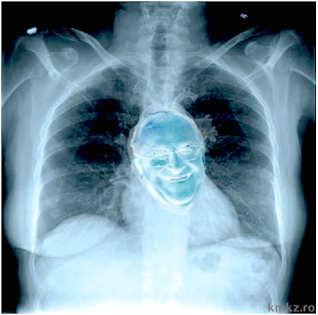 radiografie ponta