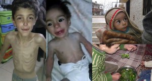 copii desfigurati foame siria