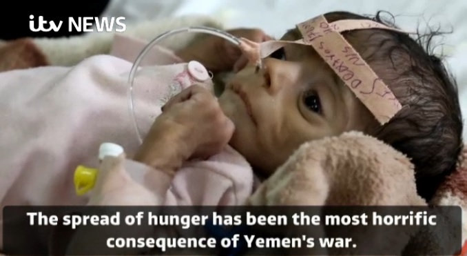 bebe-subnutrit-yemen